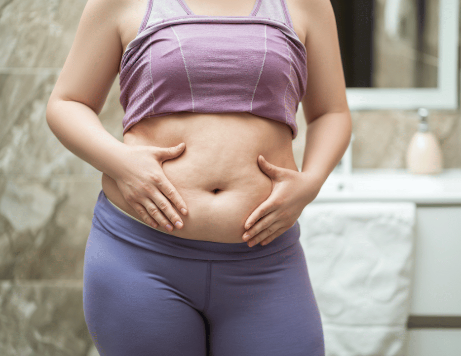 Eine Frau mit Bauchfalten, Behandlung Bauchdeckenstraffung
